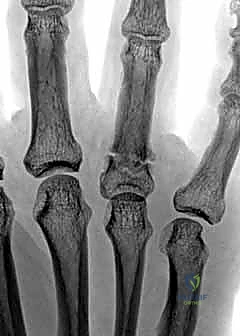 صورة توضيحية لـ كسور السلاميات خارج المفصل دليل شامل للعلاج مع الأستاذ الدكتور محمد هطيف في صنعاء