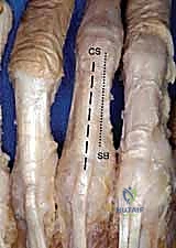 صورة توضح طريقة التثبيت بالشريط اللاصق للإصبع المجاور كعلاج تحفظي