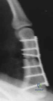 صورة أشعة سينية بوضعيات مختلفة توضح كسراً مائلاً غير مستقر في السلامية القريبة