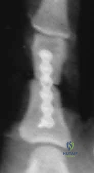 صورة طبية: كسور السلاميات خارج المفصل دليل شامل للعلاج مع الأستاذ الدكتور محمد هطيف في صنعاء