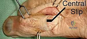 رسم توضيحي يوضح تقنية التثبيت داخل النقي لكسور السلاميات