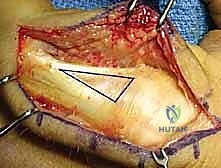 صورة طبية: كسور السلاميات خارج المفصل دليل شامل للعلاج مع الأستاذ الدكتور محمد هطيف في صنعاء