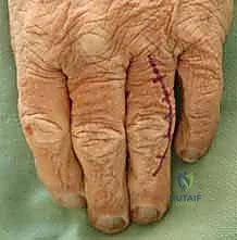 صورة شعاعية لكسر تم تثبيته بطريقة داخل النقي بنجاح