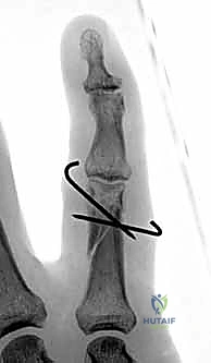 صورة طبية: كسور السلاميات خارج المفصل دليل شامل للعلاج مع الأستاذ الدكتور محمد هطيف في صنعاء