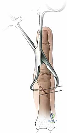 صورة طبية: كسور السلاميات خارج المفصل دليل شامل للعلاج مع الأستاذ الدكتور محمد هطيف في صنعاء
