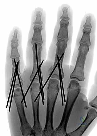 صورة توضيحية لـ كسور السلاميات خارج المفصل دليل شامل للعلاج مع الأستاذ الدكتور محمد هطيف في صنعاء