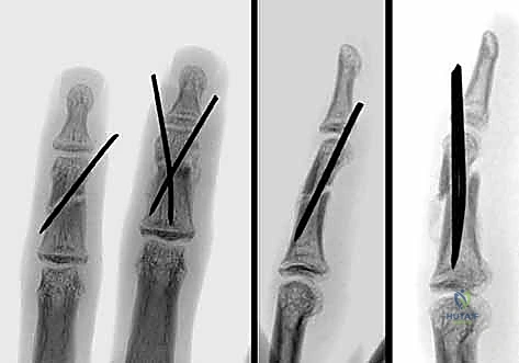 صورة طبية: كسور السلاميات خارج المفصل دليل شامل للعلاج مع الأستاذ الدكتور محمد هطيف في صنعاء