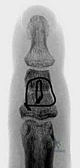 صورة طبية: كسور السلاميات خارج المفصل دليل شامل للعلاج مع الأستاذ الدكتور محمد هطيف في صنعاء