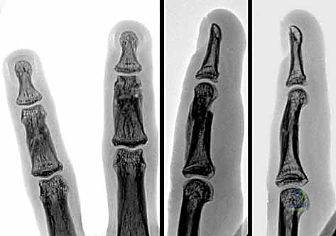 صورة شعاعية تظهر التثبيت المتقن باستخدام صفيحة وبراغي دقيقة على جانب السلامية