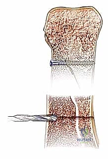 صورة طبية: كسور السلاميات خارج المفصل دليل شامل للعلاج مع الأستاذ الدكتور محمد هطيف في صنعاء