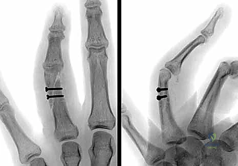 صورة طبية: كسور السلاميات خارج المفصل دليل شامل للعلاج مع الأستاذ الدكتور محمد هطيف في صنعاء