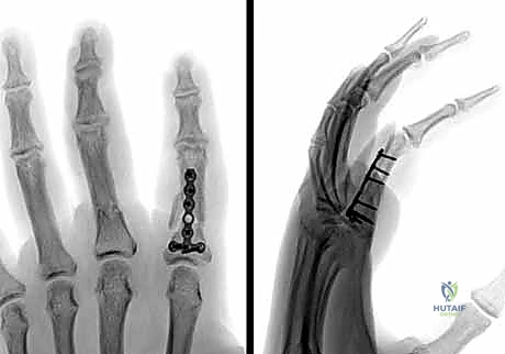 صورة سريرية للإصبع بعد التثبيت بأسلاك كيرشنر عبر الجلد