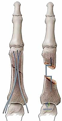 Mastering Extra-Articular Phalangeal Fracture Fixation: An Intraoperative Masterclass