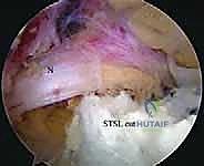 Illustration of transverse scapular ligament - Dr. Mohammed Hutaif