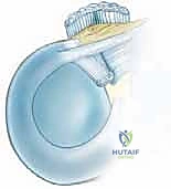 صورة رنين مغناطيسي توضح تمزق في الغضروف الهلالي