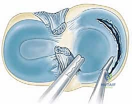 صورة توضيحية لـ استئصال الغضروف الهلالي بالمنظار: دليل شامل لعلاج تمزقات الركبة مع الأستاذ الدكتور محمد هطيف