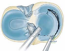 صورة توضيحية لـ استئصال الغضروف الهلالي بالمنظار: دليل شامل لعلاج تمزقات الركبة مع الأستاذ الدكتور محمد هطيف