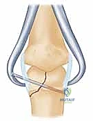 صورة توضيحية لـ كسور لقمة السلامية في الأصابع: دليل شامل للعلاج الجراحي الدقيق مع الأستاذ الدكتور محمد هطيف في صنعاء