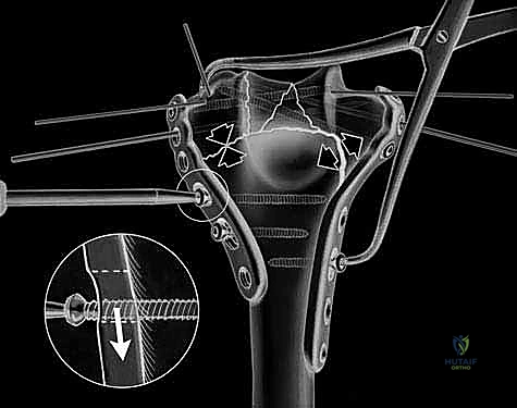 Deltopectoral Approach: Comprehensive Surgical Anatomy & Clinical Applications