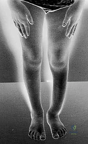 Illustration of within the tibia - Dr. Mohammed Hutaif