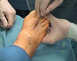 عملية وايل لتصحيح قصر مشط القدم: دليل شامل لعلاج آلام مقدمة القدم وخلع المفاصل