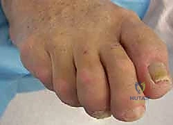 تأثير الأحذية الضيقة على أصابع القدم