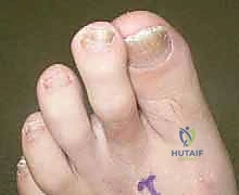 تأثير الأوتار على مفاصل أصابع القدم