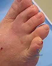 تقييم سريري لحالة تشوه في أصابع القدم