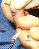 تأثير الأمراض الروماتيزمية على القدم