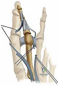 صورة توضيحية لـ تشوهات أصابع القدم الصغيرة: دليل شامل للعلاج الجراحي وغير الجراحي مع الأستاذ الدكتور محمد هطيف في صنعاء