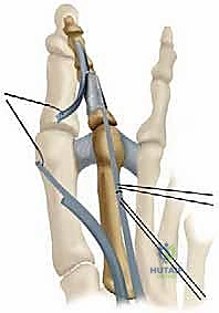 إجراء استئصال جزء من المفصل
