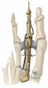 تشوه إصبع القدم المخلبية