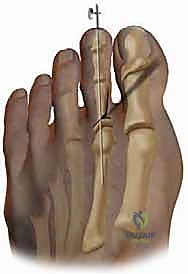 إصبع القدم المطرقية القاصية