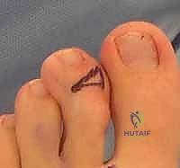 صورة شعاعية توضح اختلال العظام في القدم