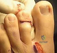 التشريح العظمي لأصابع القدم