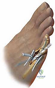 صورة توضيحية لـ تشوهات أصابع القدم الصغيرة: دليل شامل للعلاج الجراحي وغير الجراحي مع الأستاذ الدكتور محمد هطيف في صنعاء