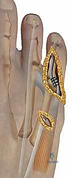 تشوهات أصابع القدم الصغيرة: دليل شامل للعلاج الجراحي وغير الجراحي مع الأستاذ الدكتور محمد هطيف في صنعاء