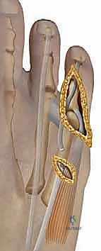 صورة توضيحية لـ تشوهات أصابع القدم الصغيرة: دليل شامل للعلاج الجراحي وغير الجراحي مع الأستاذ الدكتور محمد هطيف في صنعاء