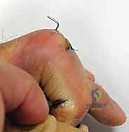 Surgical technique step for Dorsal Block Pinning of Proximal Interphalangeal Joint Fracture-Dislocations