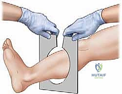 إزالة المثبت الخارجي بعد الشفاء