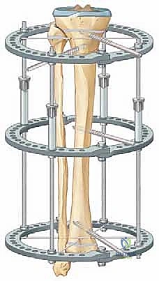 العلاج الطبيعي بعد إطالة الأطراف