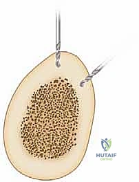 المثبت أحادي المستوى