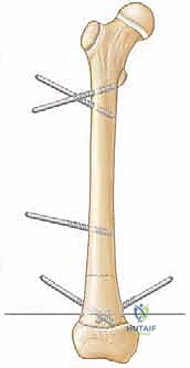 صورة توضيحية لـ إطالة الأطراف: تقنيات إليزاروف والمثبت أحادي المستوى لاستعادة الطول والوظيفة مع الأستاذ الدكتور محمد هطيف
