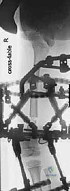 التخطيط الجراحي لإطالة الأطراف