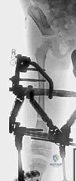 أسباب قصر الأطراف والتشوهات العظمية