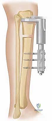 صورة توضيحية لـ إطالة الأطراف: تقنيات إليزاروف والمثبت أحادي المستوى لاستعادة الطول والوظيفة مع الأستاذ الدكتور محمد هطيف