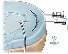 Arthroscopic Meniscal Repair: An Intraoperative Masterclass in Knee Preservation