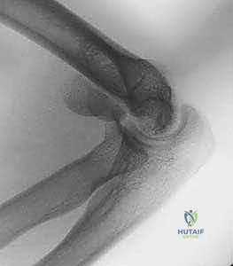 Masterclass: ORIF of Capitellum and Capitellar–Trochlear Shear Fractures