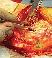 Orthopedic Prometric MCQs - Chapter 3 Part 22