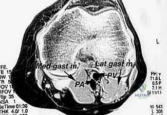 Illustration of greater saphenous vein - Dr. Mohammed Hutaif